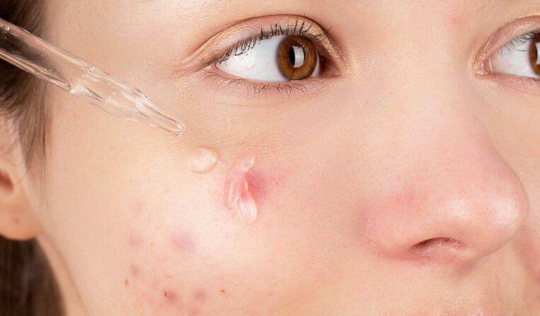 salicylic acid serum